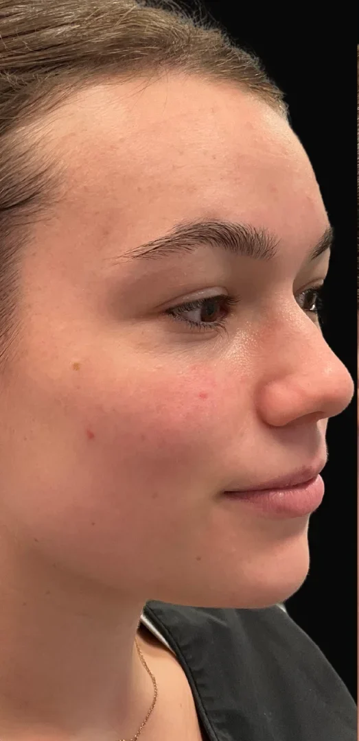 julia before treatment with emmi aesthetic in boston