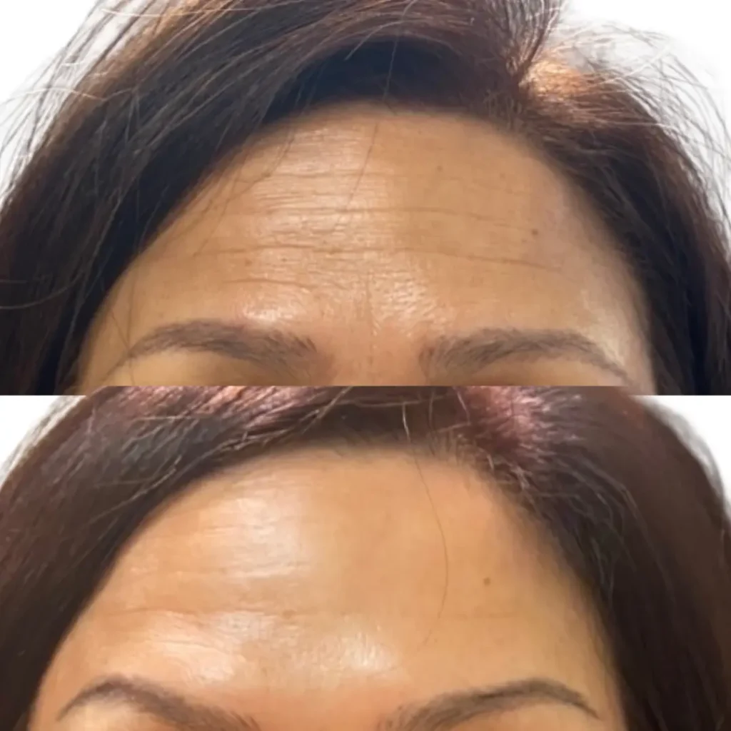 forehead lines botox