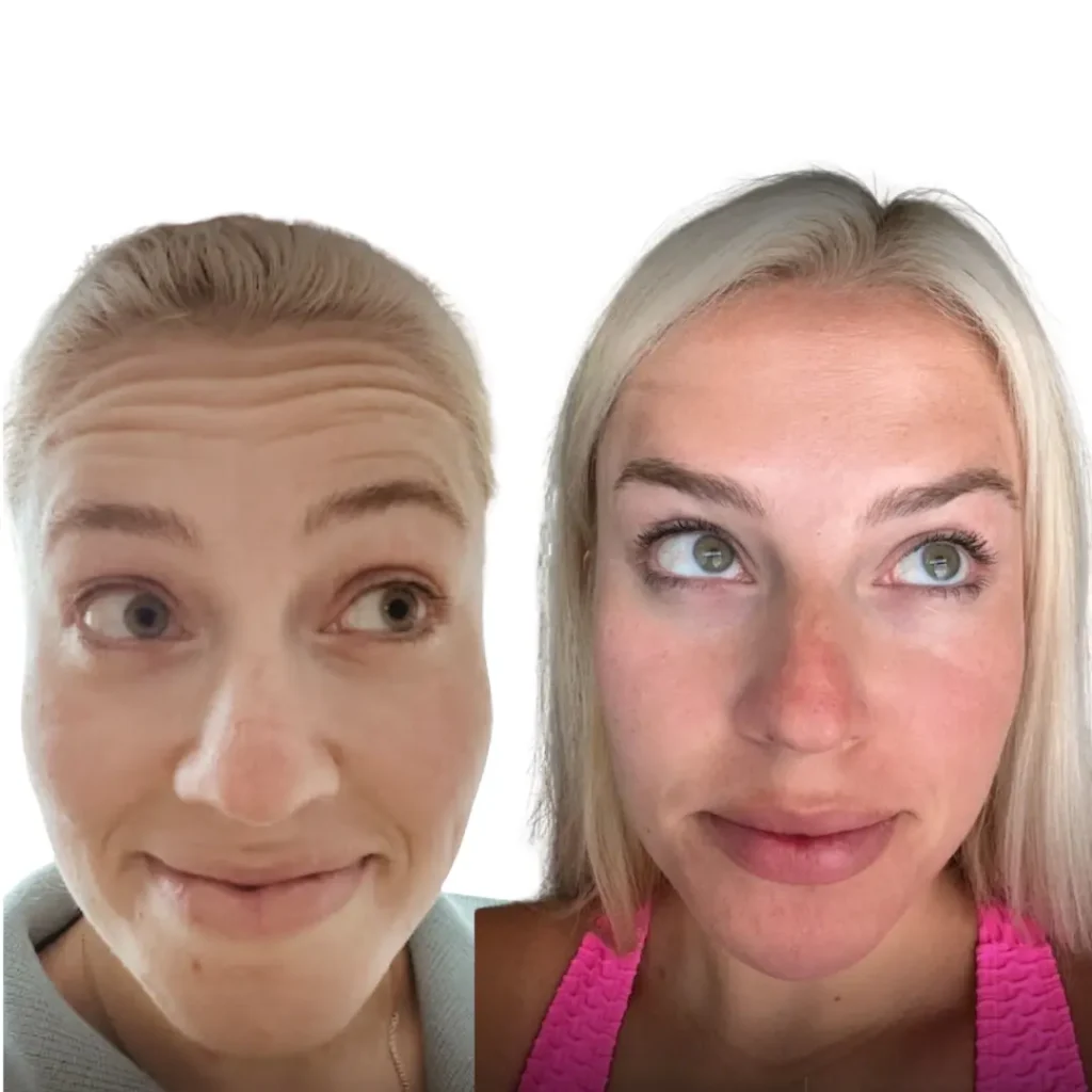 before and after botox treatment in boston by emmi aesthetic