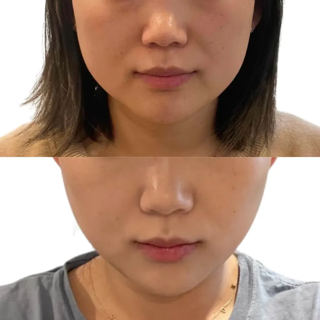 masseter botox in boston done by the emmi aesthetic