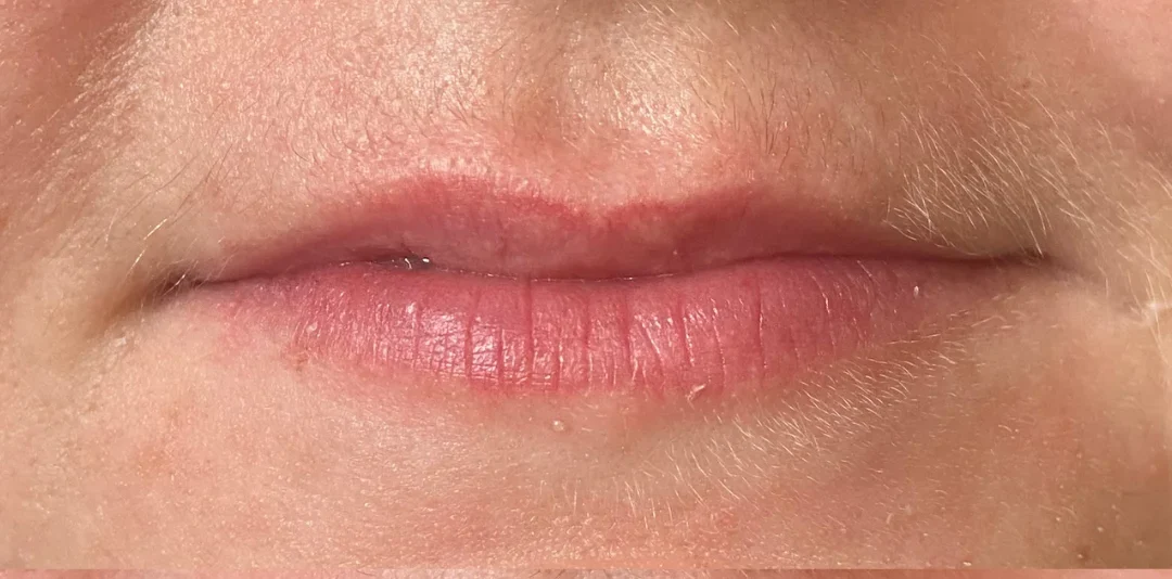 before lip fillers by emmi aesthetic