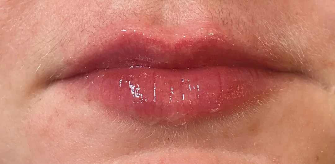 lip filler after treatment with emmi aesthetic